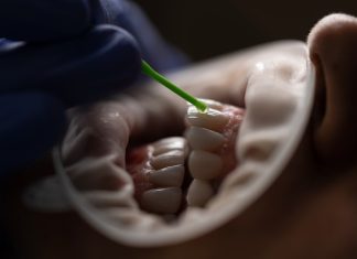3 mituri despre albirea dintilor pe care NU trebuie sa le mai crezi